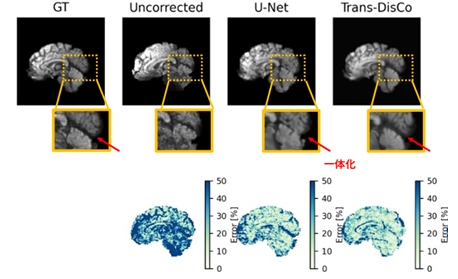 深層学習による拡散MRIの画像歪み補正の研究